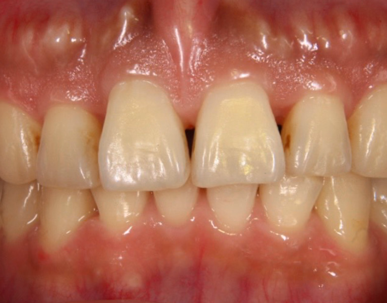 ホワイトニング前の前歯のアップ。わずかな黄ばみや色ムラが見られる。