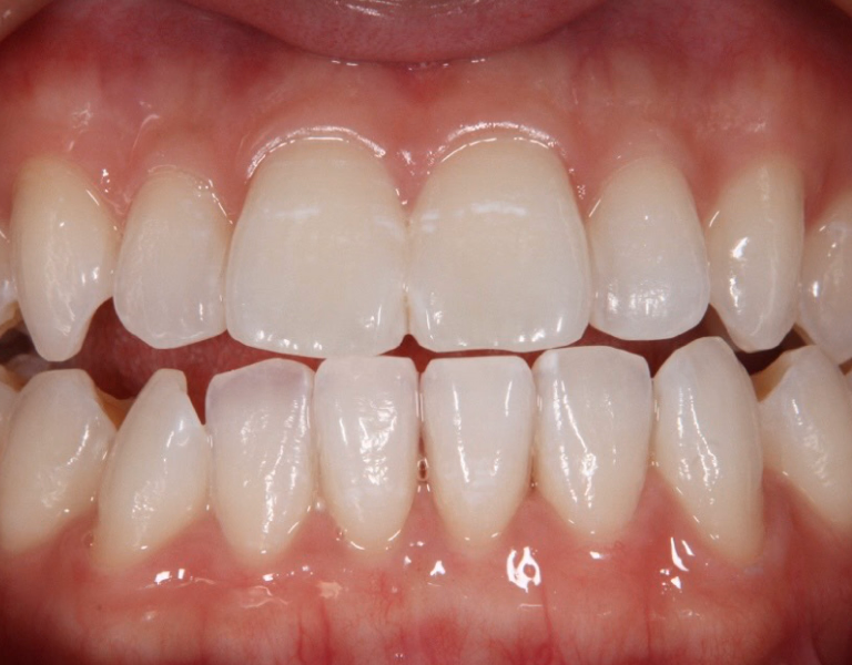 ホワイトニング後の歯の写真。全体的に明るく均一な白さに改善されている。