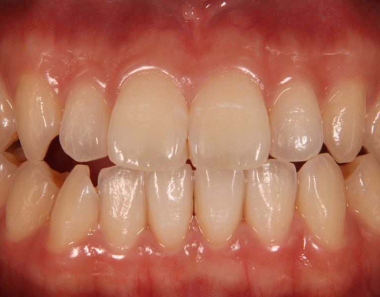 ホワイトニング前の歯の写真。前歯に黄ばみや色の不均一さが見られる。