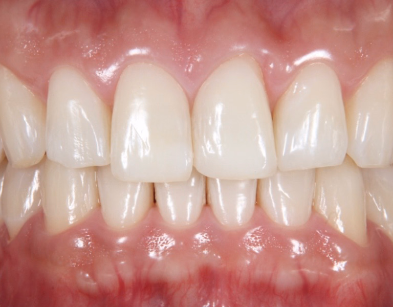 ホワイトニング後の歯。明るい白さが均一に広がり、清潔感のある見た目になっている。