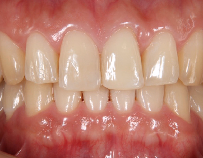 ホワイトニング前の歯。全体に暗めの色合いが見られ、黄ばみが目立つ。