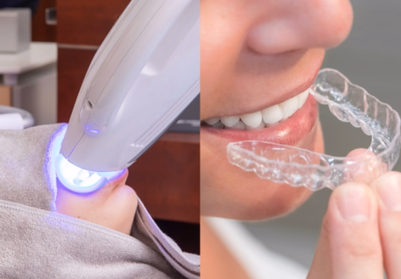 オフィスホワイトニングのライト照射と、自宅用ホワイトニングトレー装着の比較イメージ。