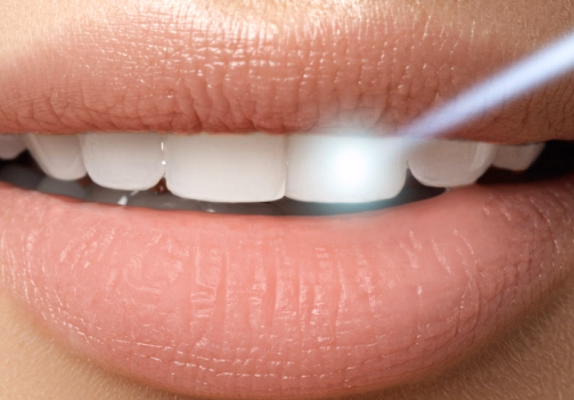 ホワイトニングライトを歯に照射している施術中の口元のクローズアップ。